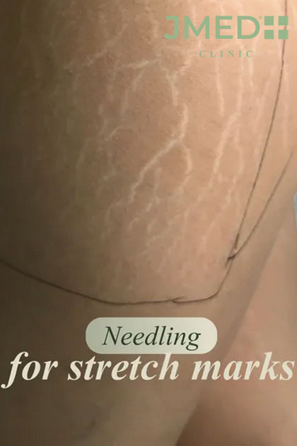 Italian-Inspired Stretch Marks Treatment