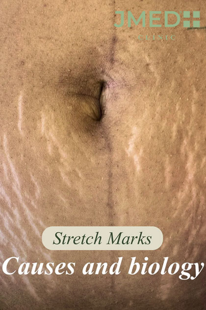 World's No.1 Stretch Marks Removal Specialist World's No.1 Stretch Marks Removal Specialist