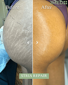 Stretch Marks Treatment Dubai