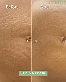Stretch Mark Treatment Dubai
