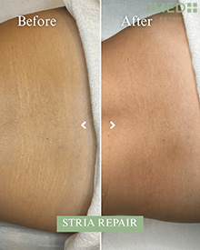 Stretch Marks Treatment In Dubai