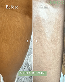 Stretch Mark Removal Clinic Near Me