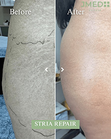 Stretch Marks Removal Dubai