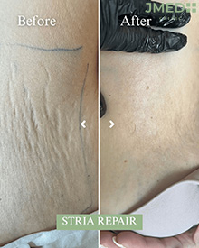 Stretch Marks Clinic Dubai