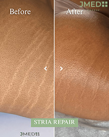Stretch Marks Removal Clinic Near Me