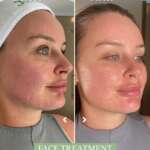 How to Tighten Loose Skin After Weight Loss Without Surgery