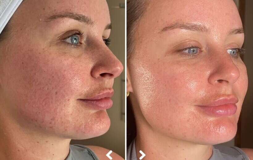 How to Tighten Loose Skin After Weight Loss Without Surgery