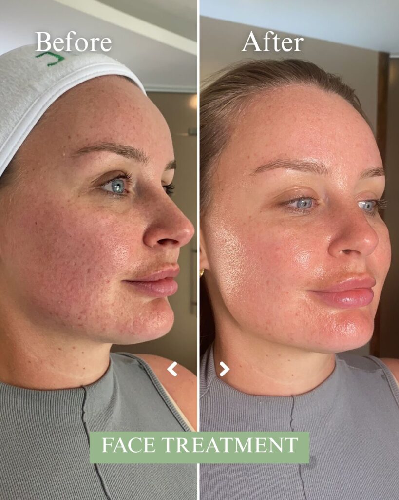How to Tighten Loose Skin After Weight Loss Without Surgery