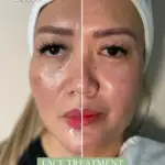 Which Treatment Gives the Fastest Results for Glowing Skin?