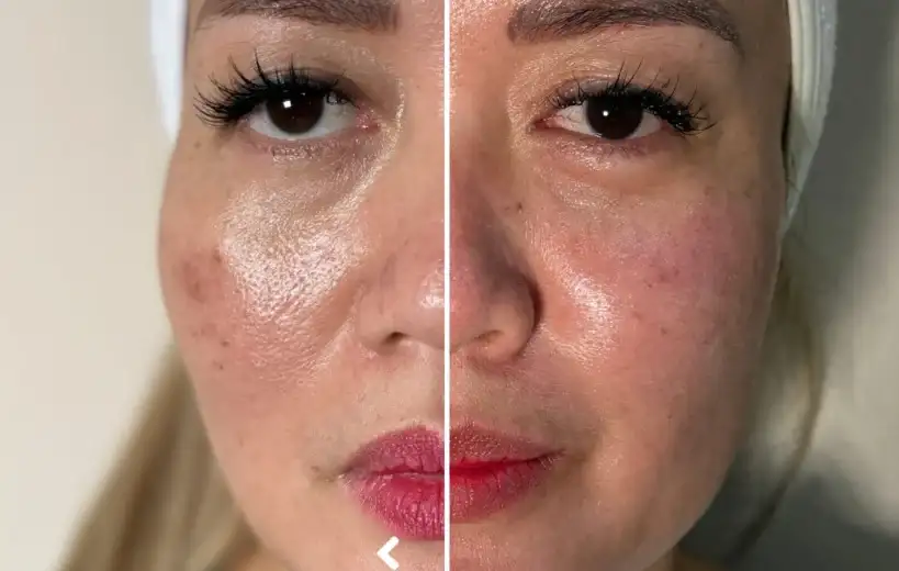 Which Treatment Gives the Fastest Results for Glowing Skin?