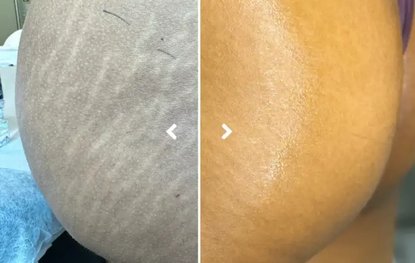 How to Fade Stretch Marks on Thighs, Stomach & Hips