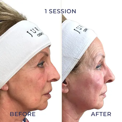 Stretch Marks Removal In Al Barsha Stretch Marks Removal In Al Barsha