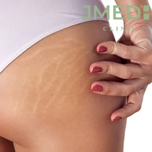 What is the Solution of Teenage Stretch Marks?