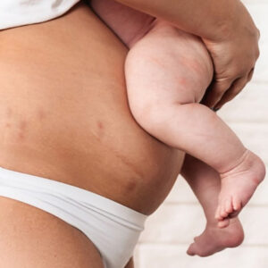 Body Contouring After Pregnancy: What You Should Know About Regaining Your Confidence Naturally