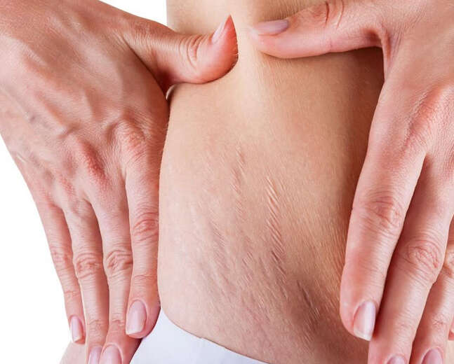 How to Treat Red Stretch Marks Before They Turn White