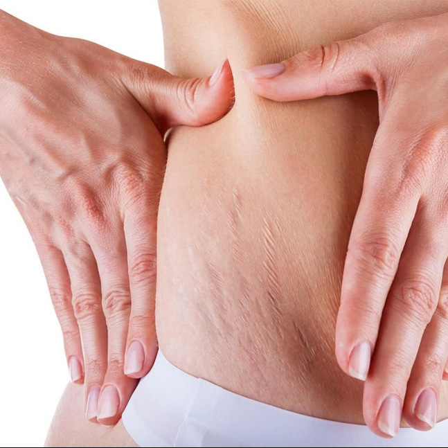 How to Treat Red Stretch Marks Before They Turn White