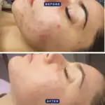 Best Treatments for Oily and Acne-Prone Skin: Expert Guide to Clearer, Healthier Skin