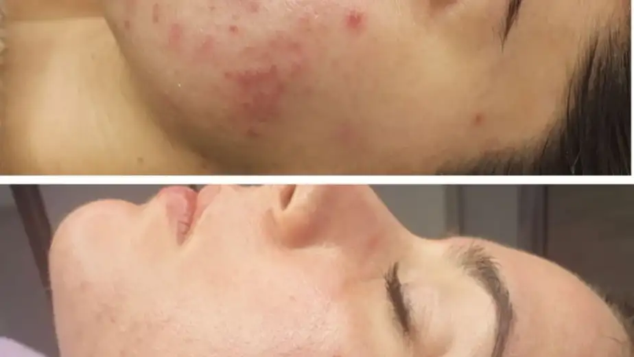 Best Treatments for Oily & Acne-Prone Skin | JMED Clinic
