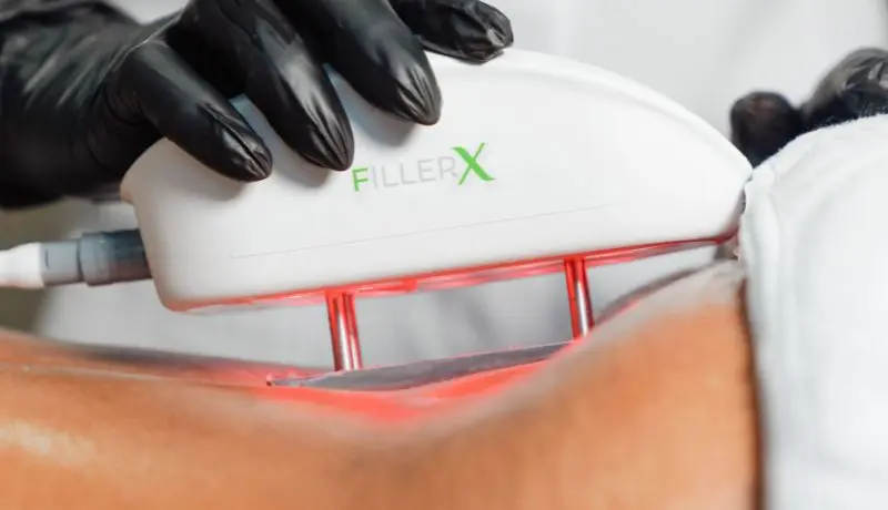 JMED FILLER X DEVICE JMED FILLER X DEVICE