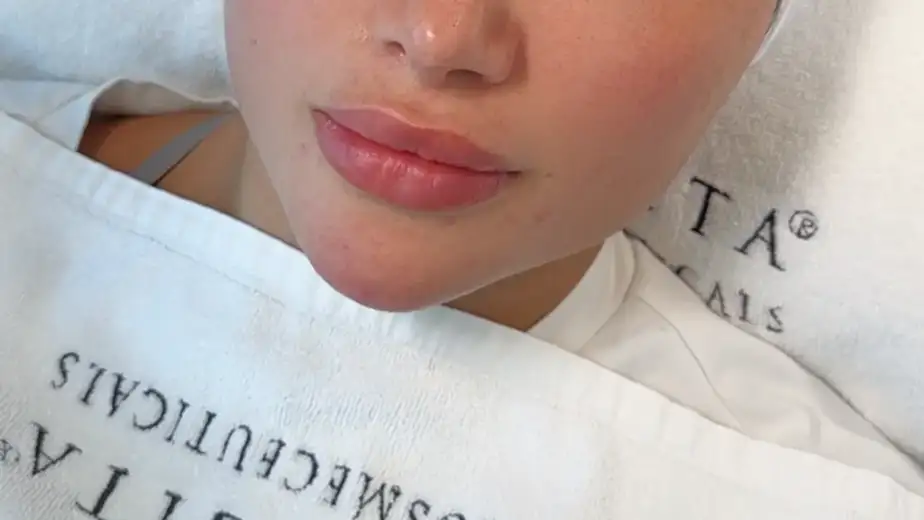 Best Facial For Bride Before Marriage