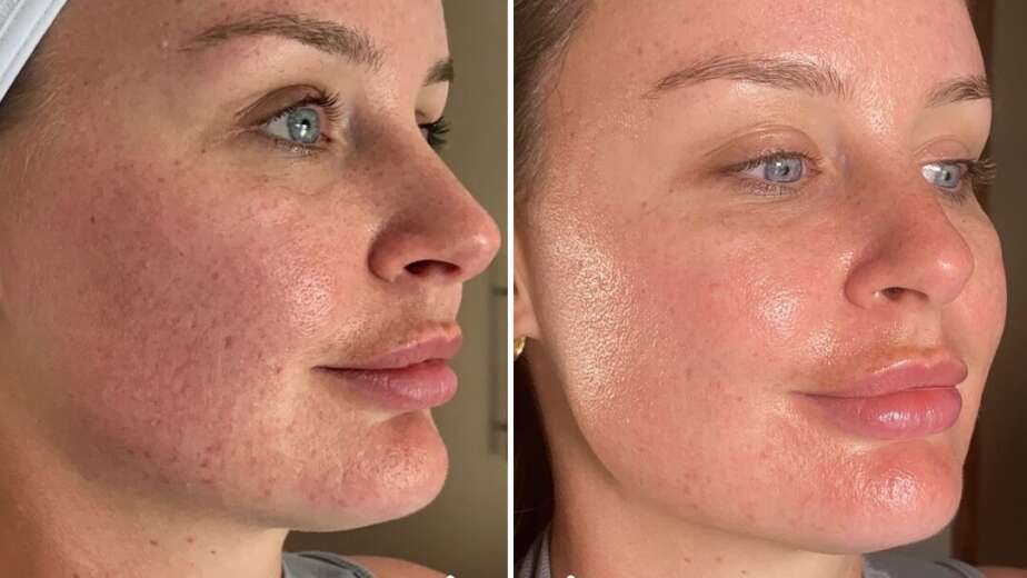 Best Hyper Pigmentation Treatment Clinic In Dubai