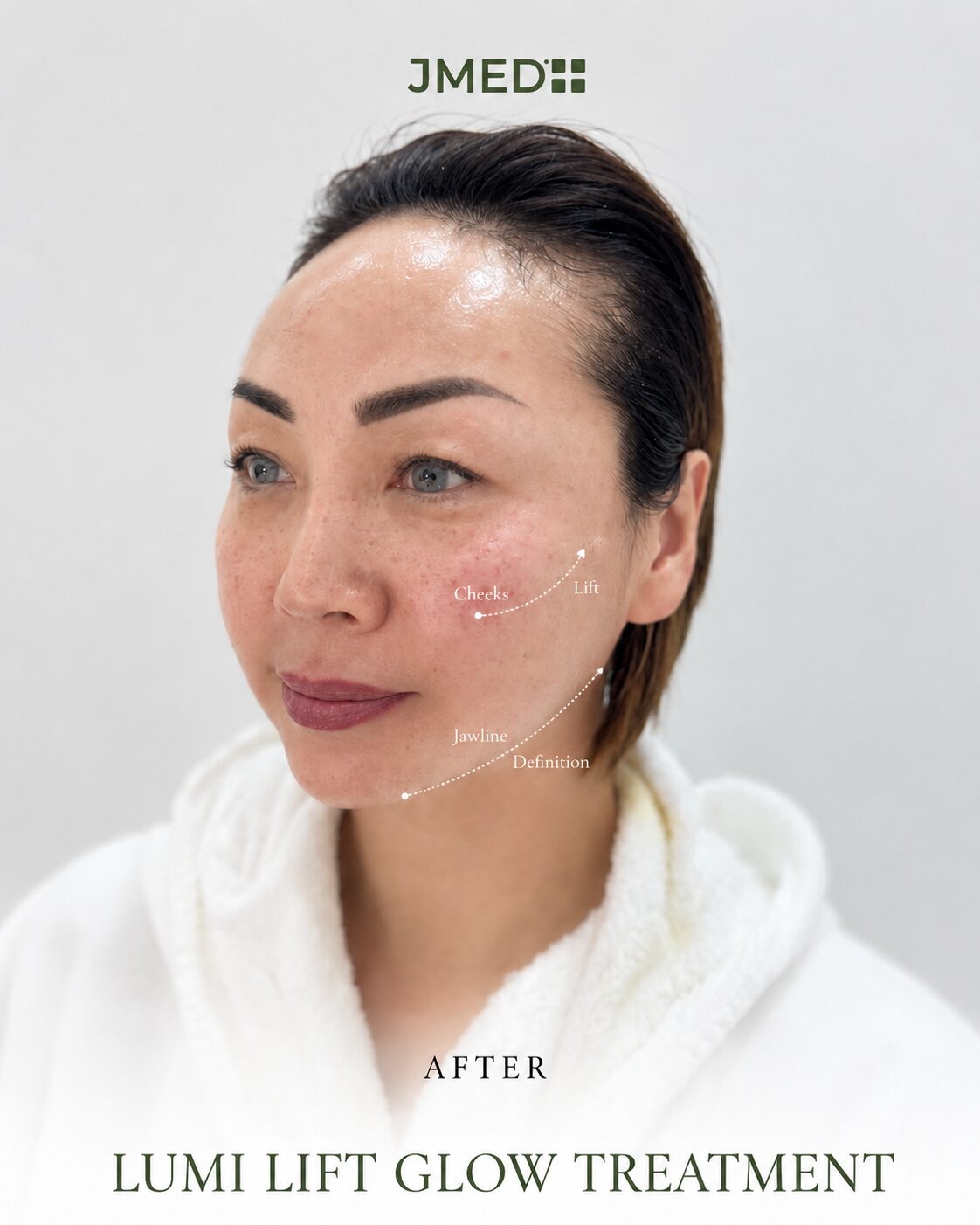 Lumi Lift Glow Face Treatment in Dubai at JMED Clinic