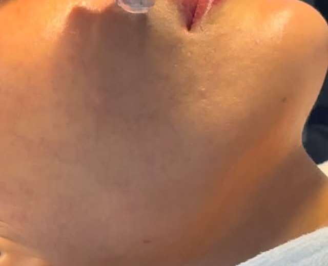 Best Skin Tightening Treatments for Face in Dubai