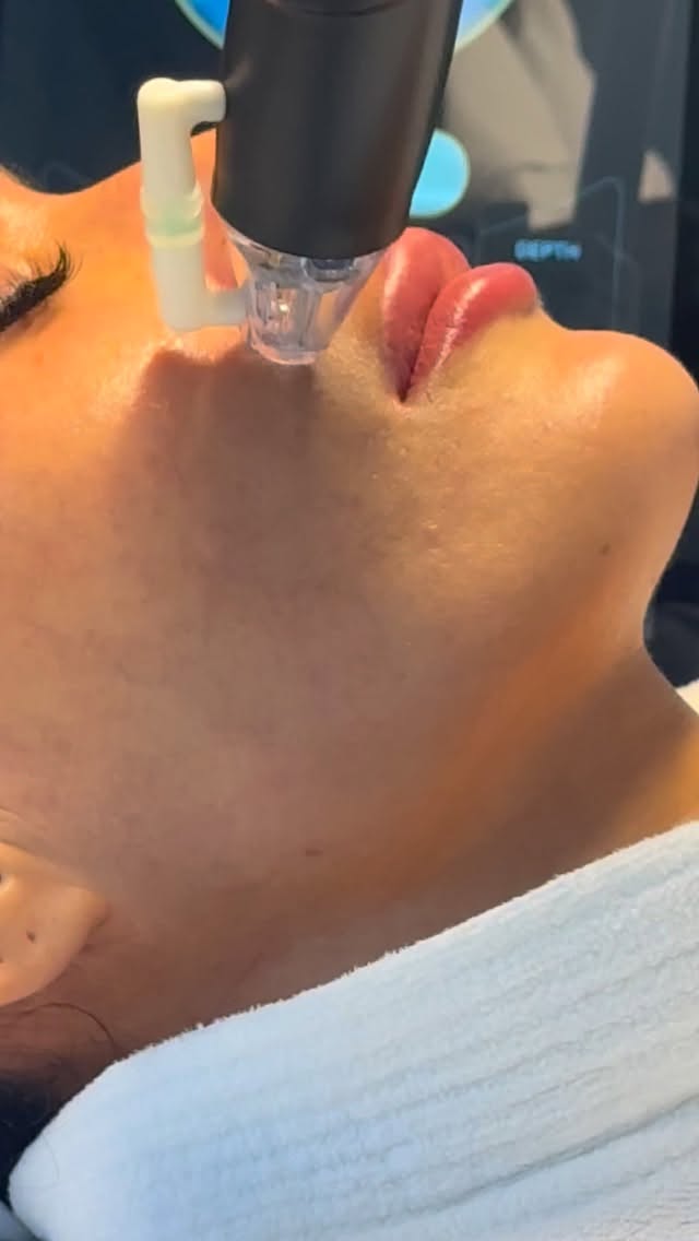 Fractional RF Microneedling: Benefits for Acne Scars, Wrinkles, and Skin Tightening