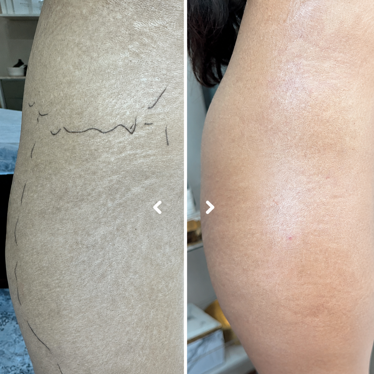 Body Contouring