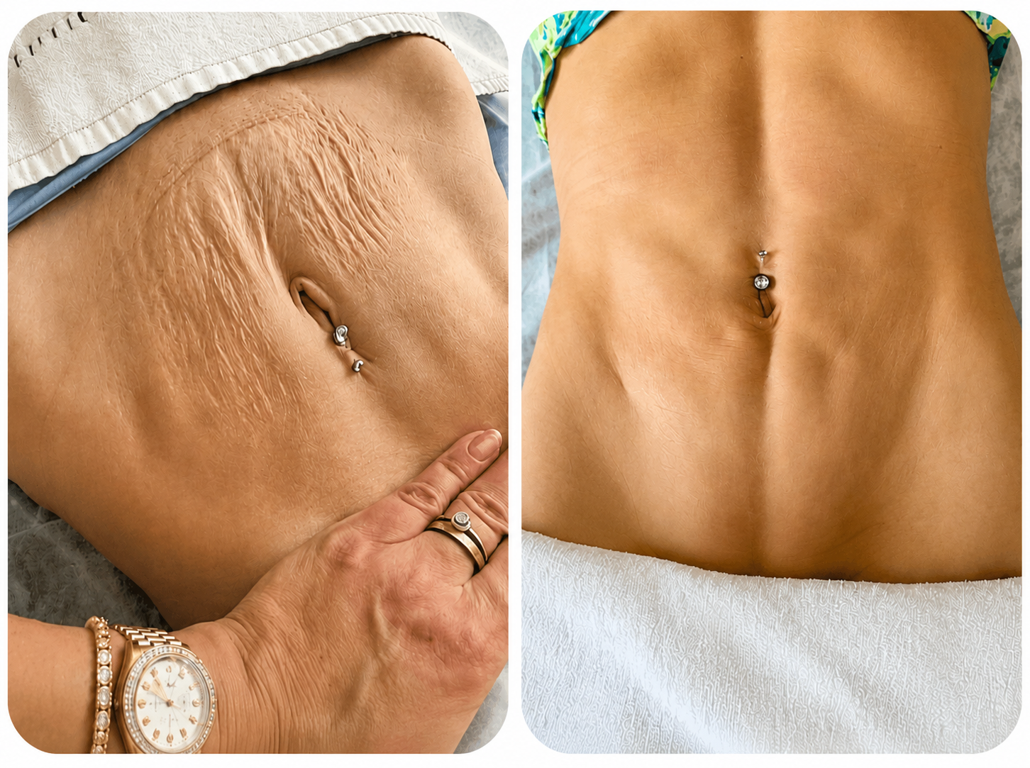 Skin Tightening