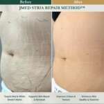 Red vs White Stretch Marks: Which Is Easier to Treat?