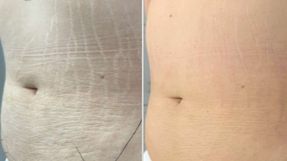 Red vs White Stretch Marks: Which Is Easier to Treat?