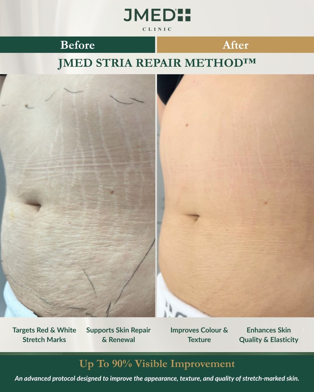 Red vs White Stretch Marks: Which Is Easier to Treat?