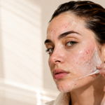 Advanced Peeling Treatment at JMED Clinic: Personalised Solutions for Clearer, Brighter, Healthier Skin