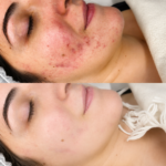 How to Treat the Different Types of Acne Scars in Dubai