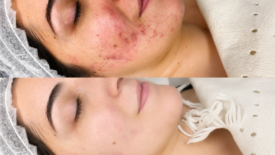 How to Treat the Different Types of Acne Scars in Dubai
