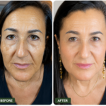 Facelift Recovery Timeline, Expectations, and Tips for Optimal Results