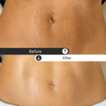 How to Treat Different Types of Stretch Marks: A Complete Guide to Advanced Stretch Marks Treatment