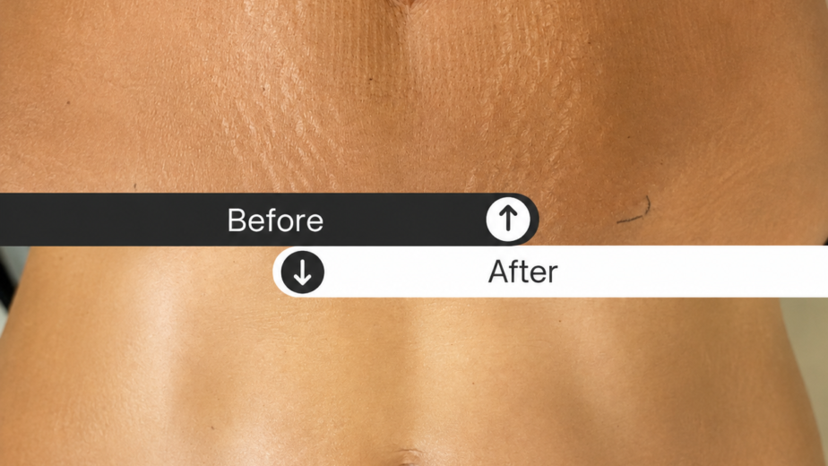 How to Treat Different Types of Stretch Marks