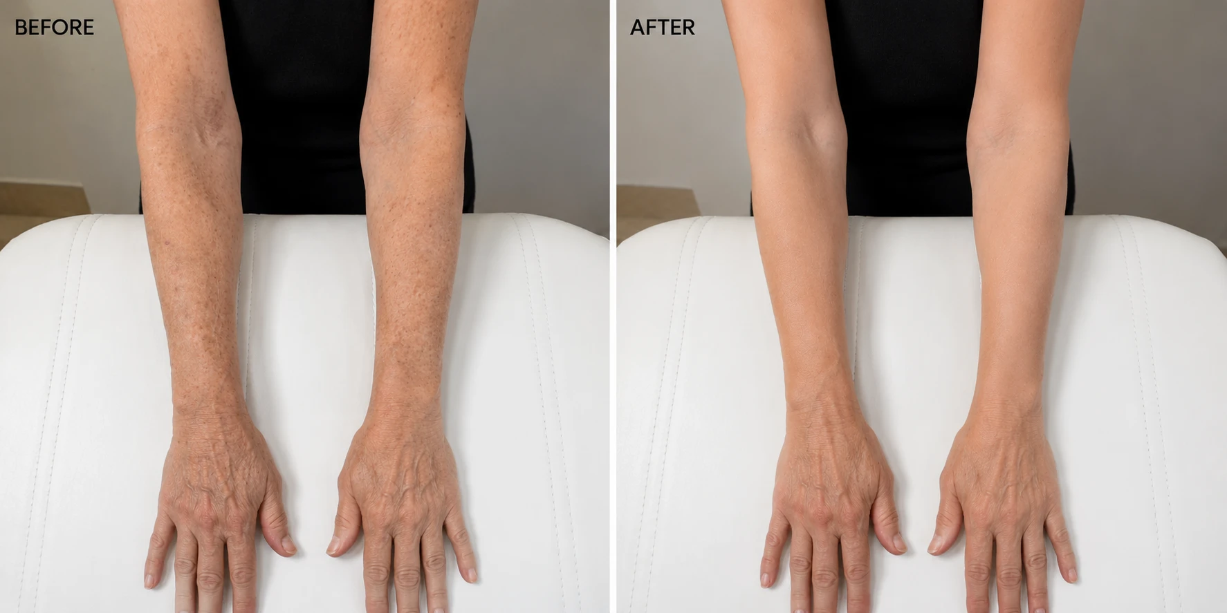 BBL Arms Rejuvenation