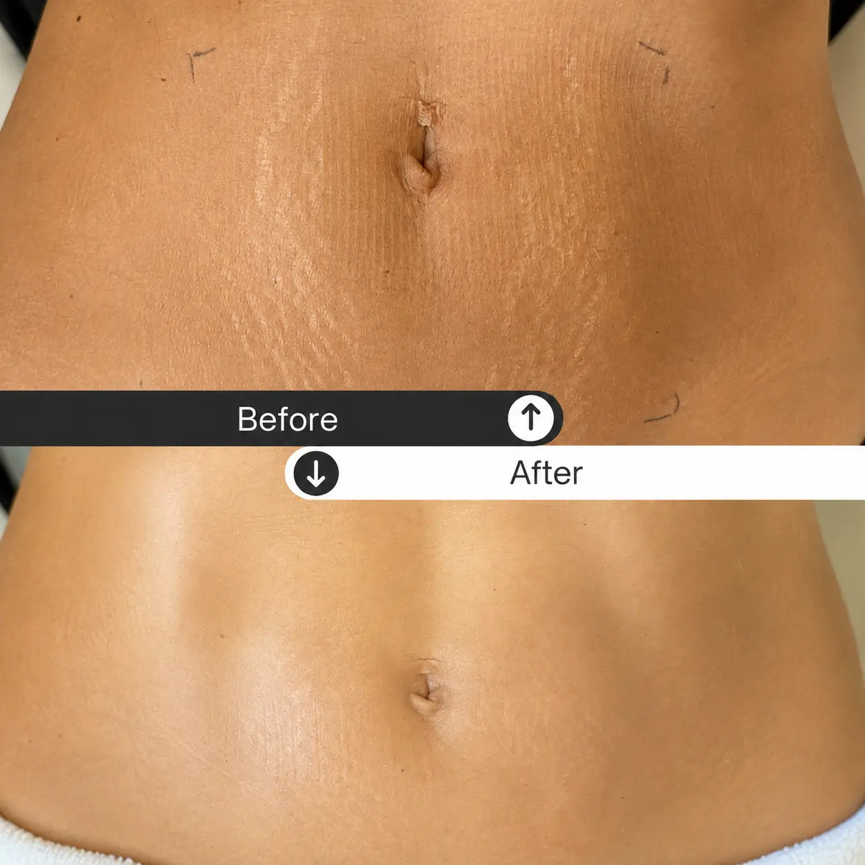Body Contouring