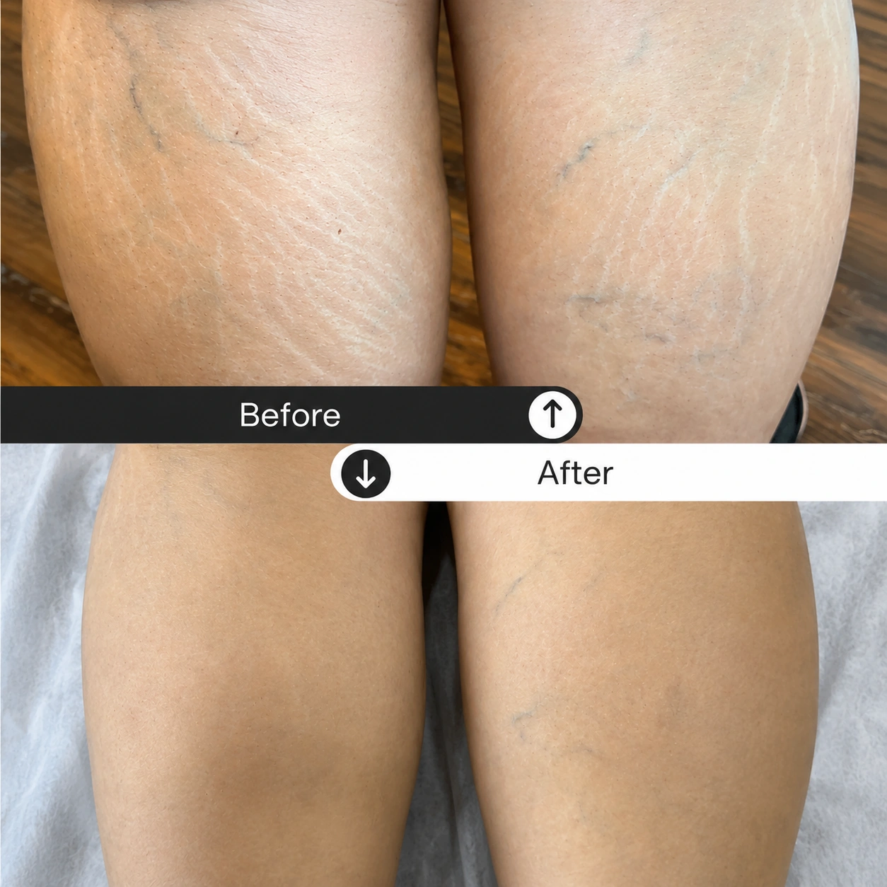 Stretch-mark-removal-treatment-Dubai