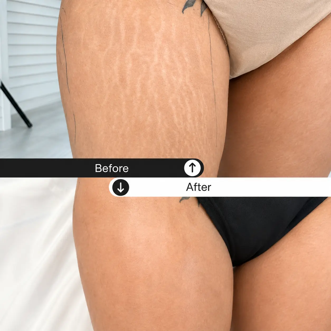 stretch-mark-JMED-Result