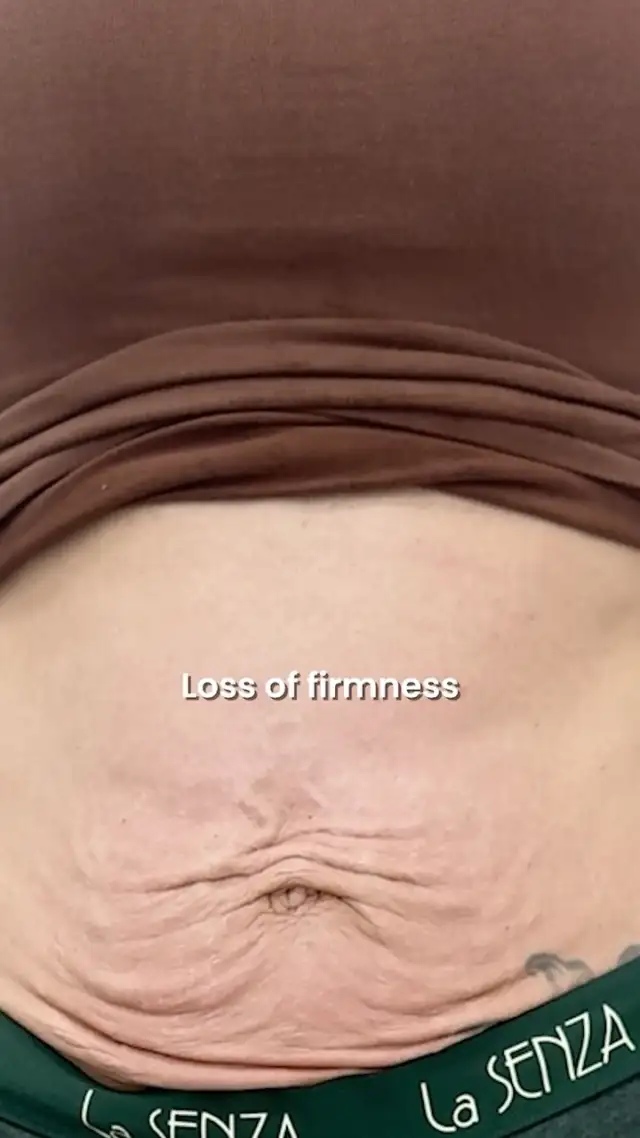 If you haven’t heard of non-invasive body tightening by now… where have you been? 👀

our advanced non-invasive treatment combining RF + Vacuum Technology to help tighten loose skin, improve the appearance of cellulite, support collagen production, and redefine your body contours.

No surgery. No downtime. Just a treatment plan customized around your body and your goals.

💚 Complimentary body consultation
✨ Limited offer: Buy any 2 body treatments & receive 1 complimentary

DM us to start your personalized body transformation at JMED Clinic, Dubai.

#JMEDClinic #PerfectShape #BodyTightening #BodyContouring #NonInvasiveBodyTreatment DubaiClinic