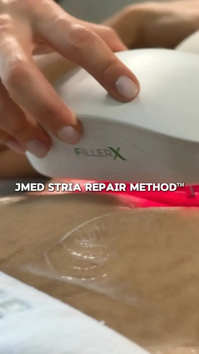 A unique method created specifically for stretch mark regeneration.

JMED Stria Repair Method™ combines advanced technologies with premium Italian cosmeceuticals in one specialized protocol designed to visibly regenerate the appearance of stretch marks.

Visible results in 3–5 sessions.
Minimally invasive. No downtime.

A unique method. Advanced technology. Premium Italian cosmeceuticals.

Available exclusively at @jmedofficial  Dubai.

DM us to book your consultation.